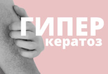 Удаление гиперкератоза: современные подходы в дерматологии