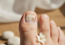 Откуда берётся грибок на ногтях и коже стоп?